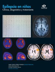 Epilepsia en niños : clínica, diagnóstico y tratamiento cover image