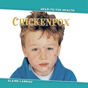 Chickenpox cover image