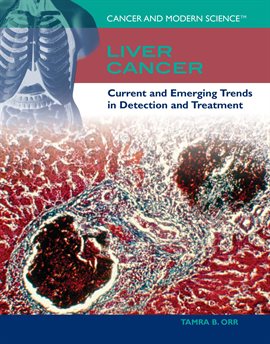 Cover image for Liver Cancer